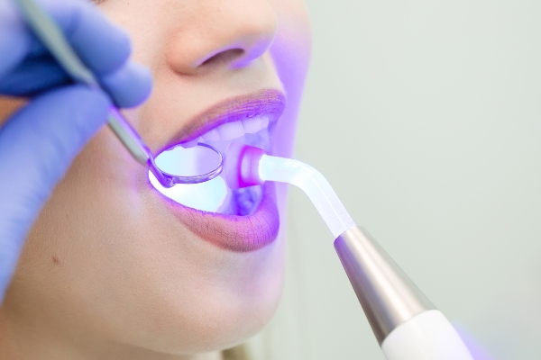 How Dental Fillings Prevent Further Tooth Decay